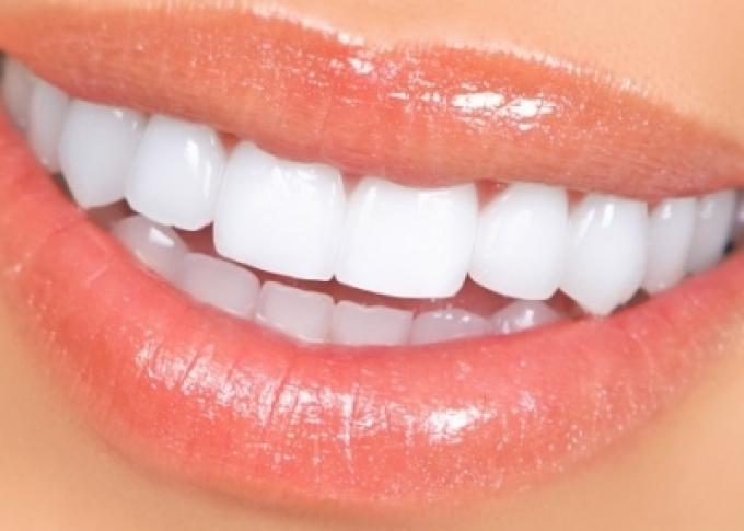 установка виниров Dental Studio